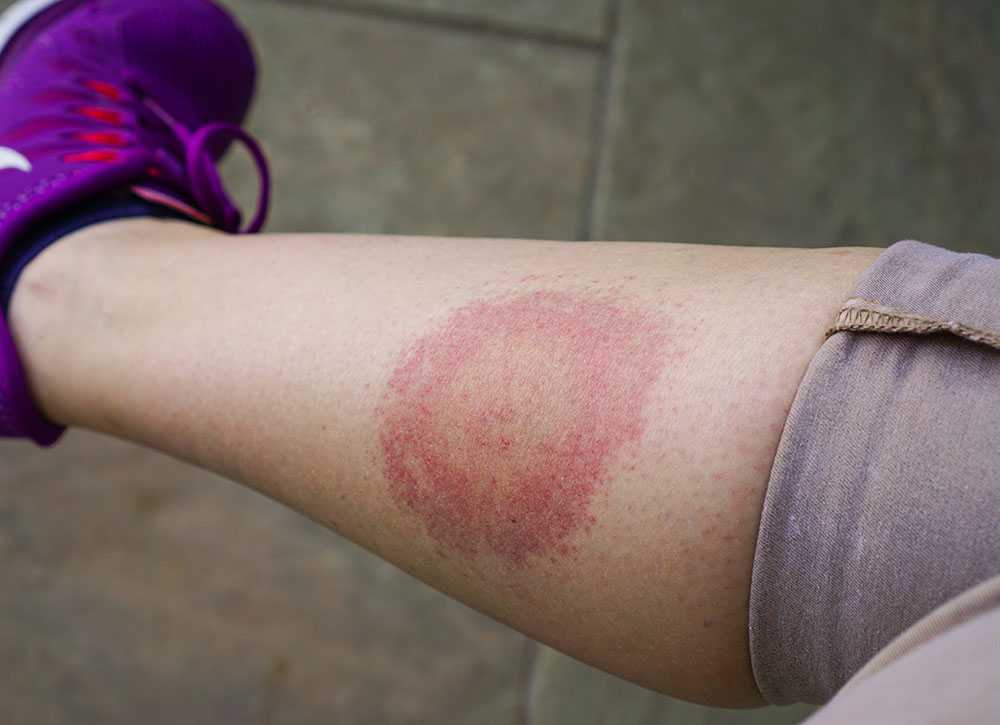 lyme disease on leg